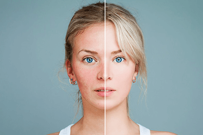 accutane en ligne