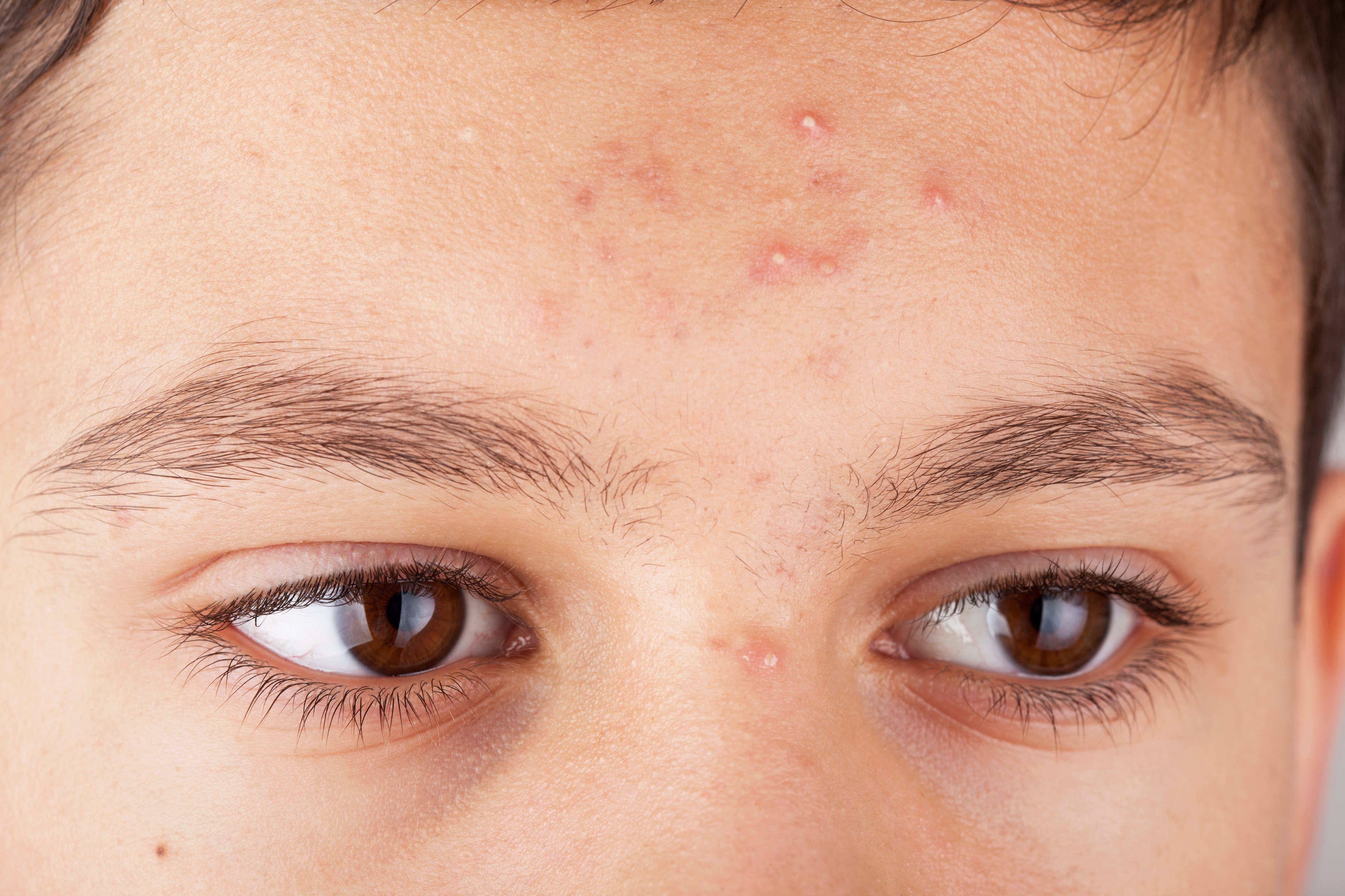 Accutane en ligne