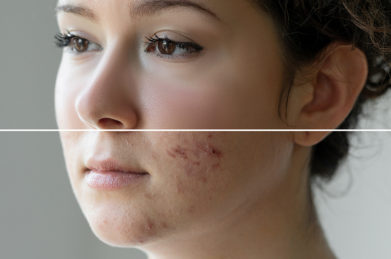 Accutane France
