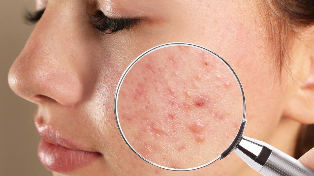 Accutane Online