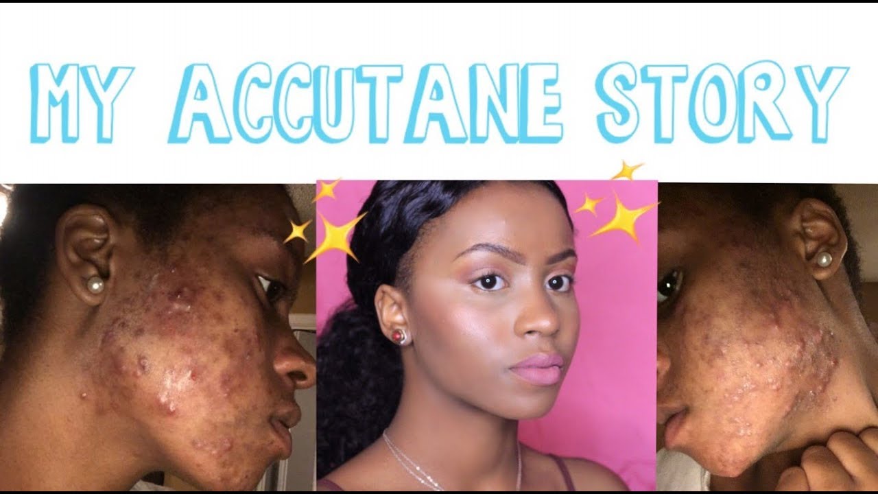 Accutane Online Italia