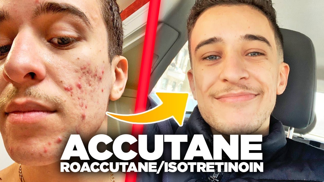 acheter du isotrétinoïne
