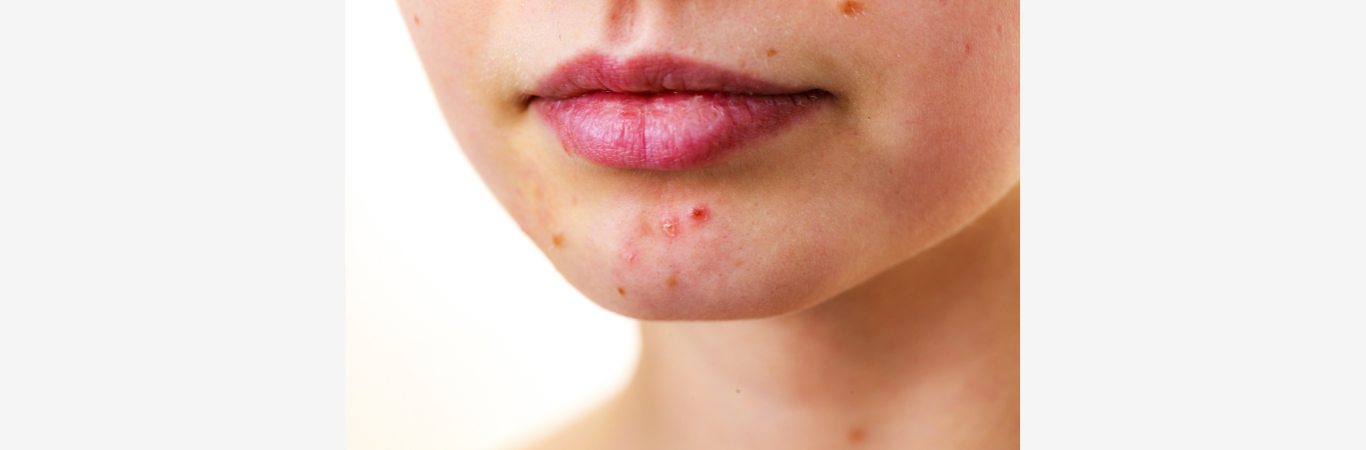 Acheter du roaccutane