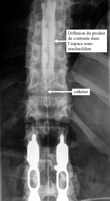 Coût Baclofène