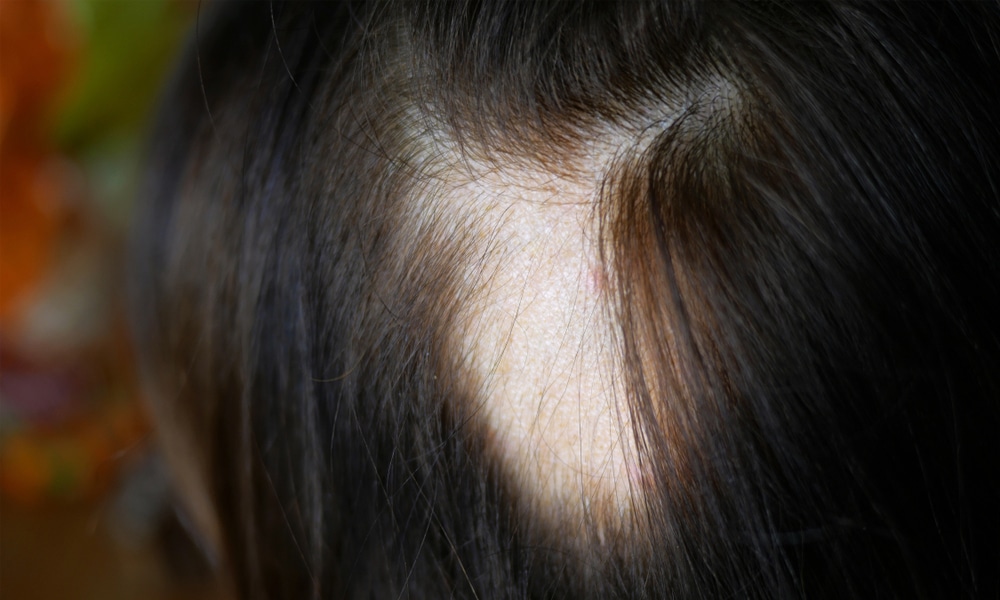 Finasteride Moins Cher