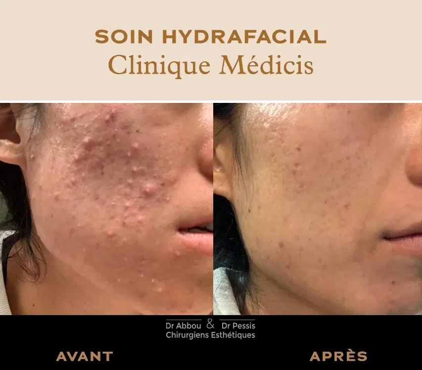 prix roaccutane france