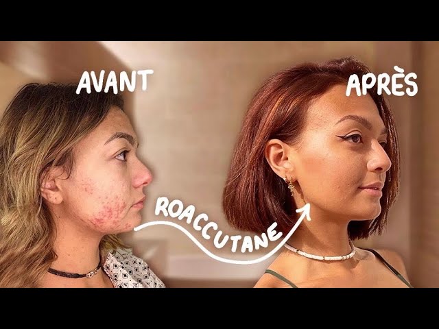 Roaccutane Comment Acheter