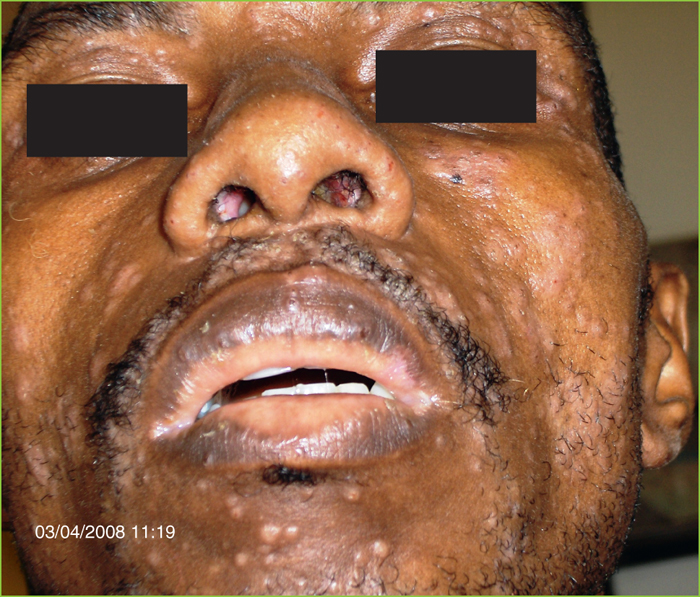 coût du fluconazole