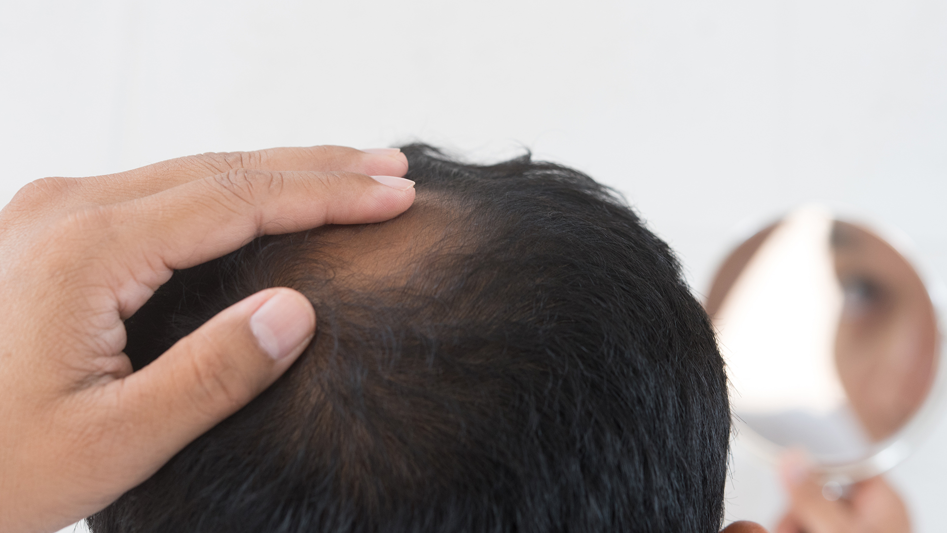 Finasteride 1mg
