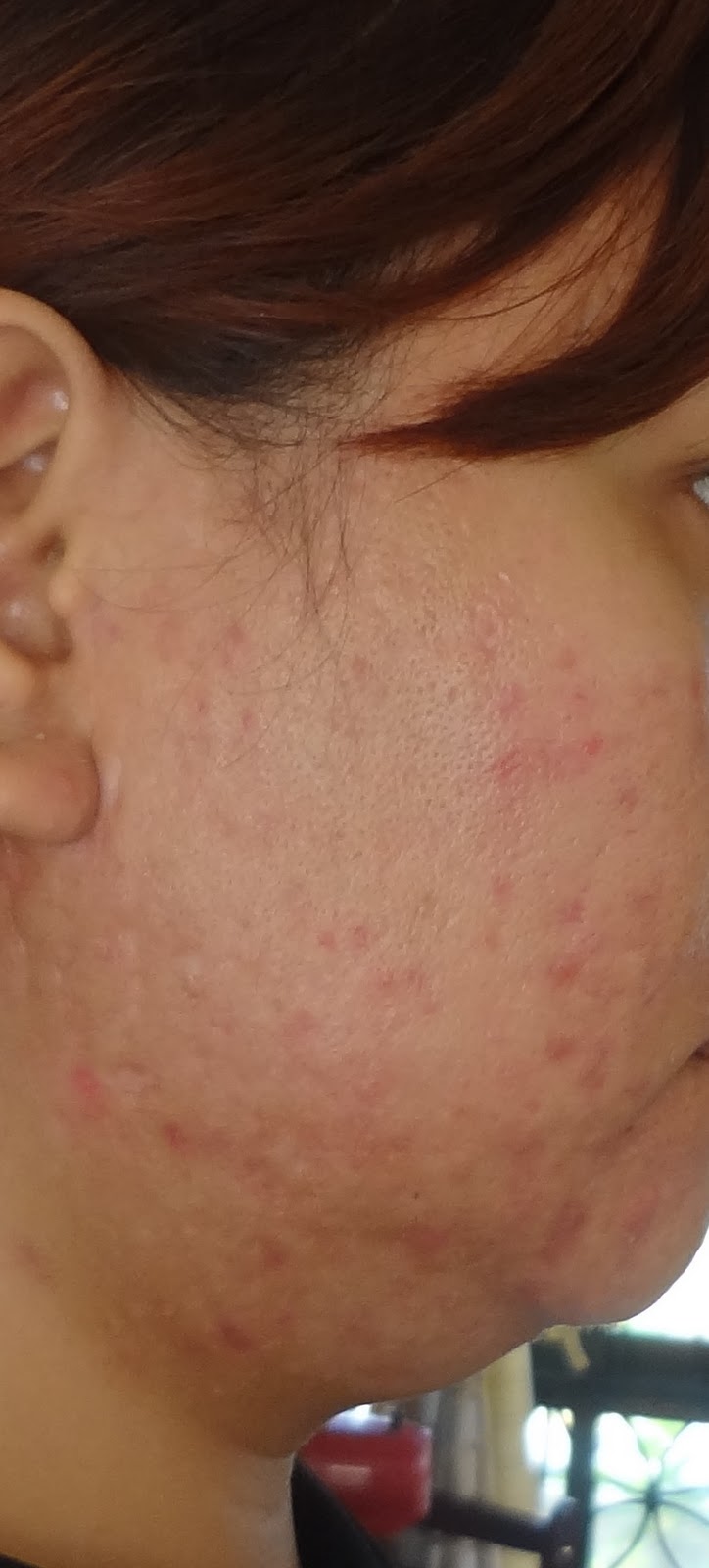 Commander du roaccutane