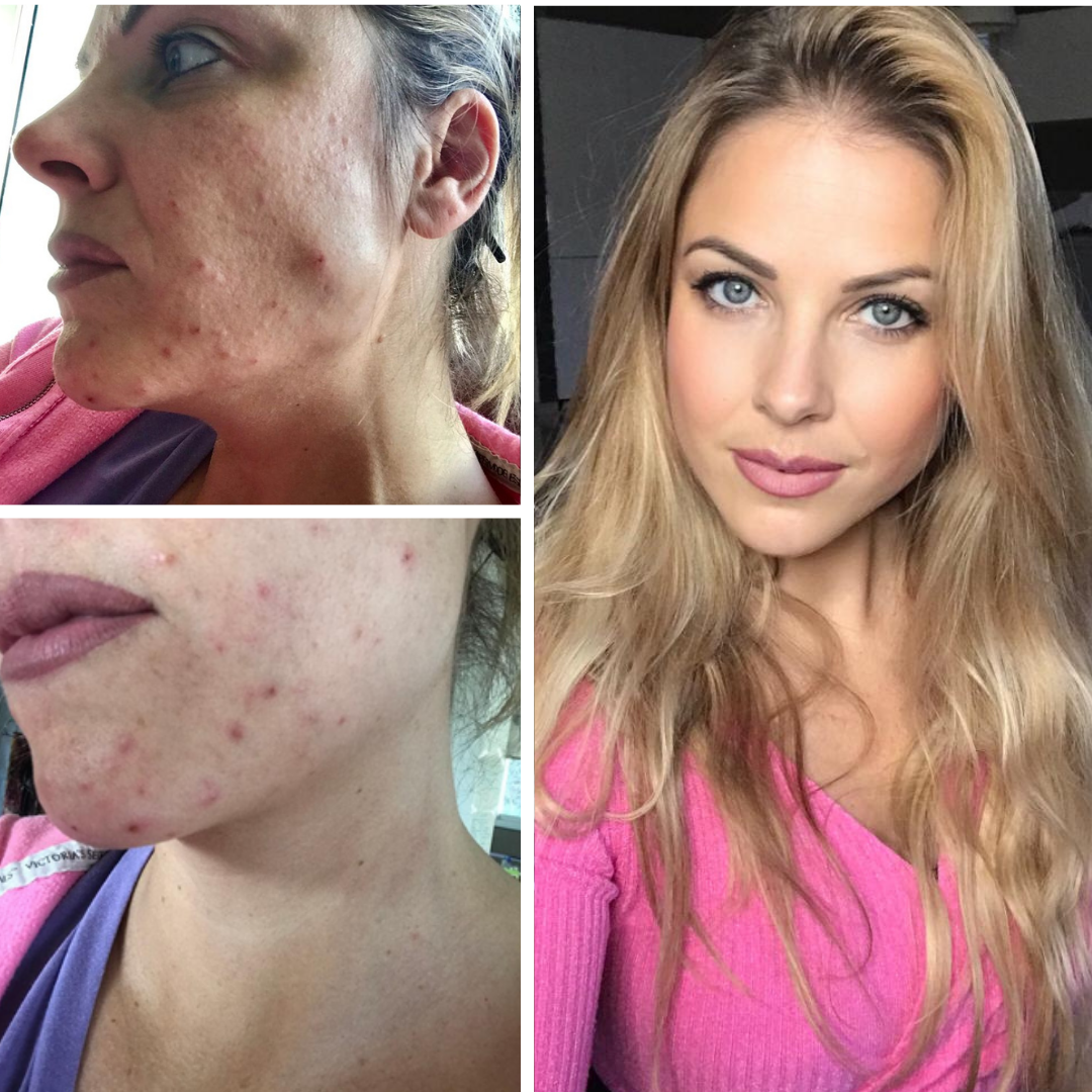 Roaccutane générique