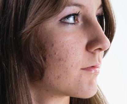 Isotretinoin france