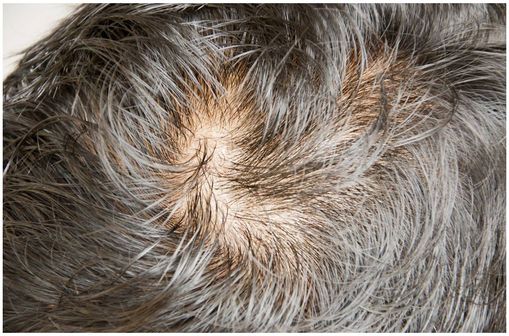 Finasteride Comment Acheter