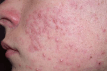 Commander accutane