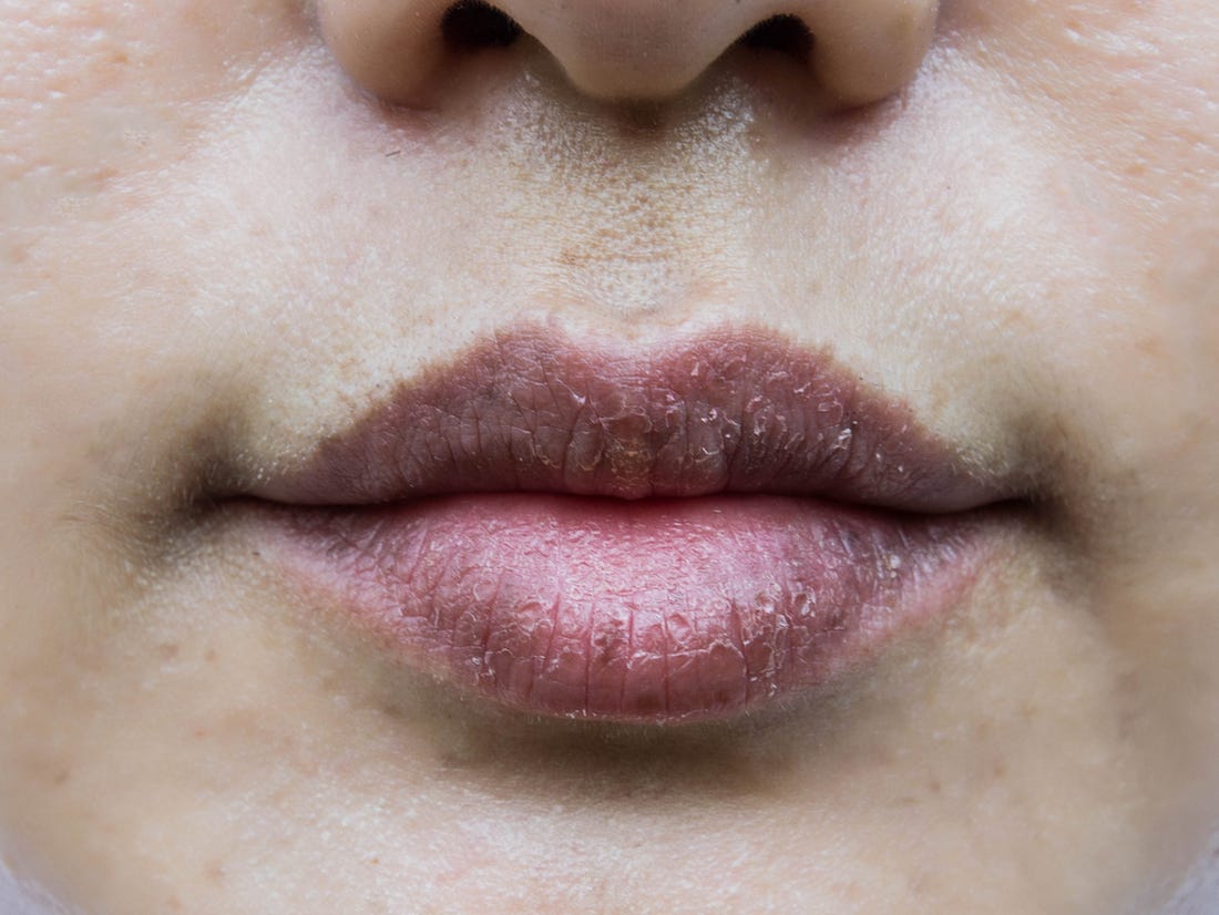 Roaccutane en france