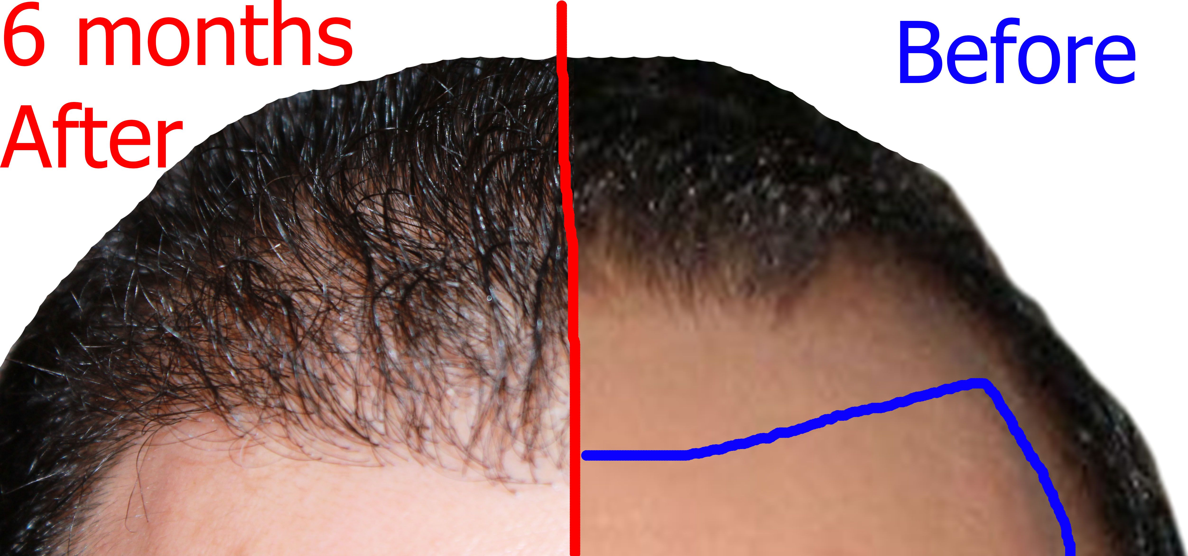 Finasteride 1mg En Ligne
