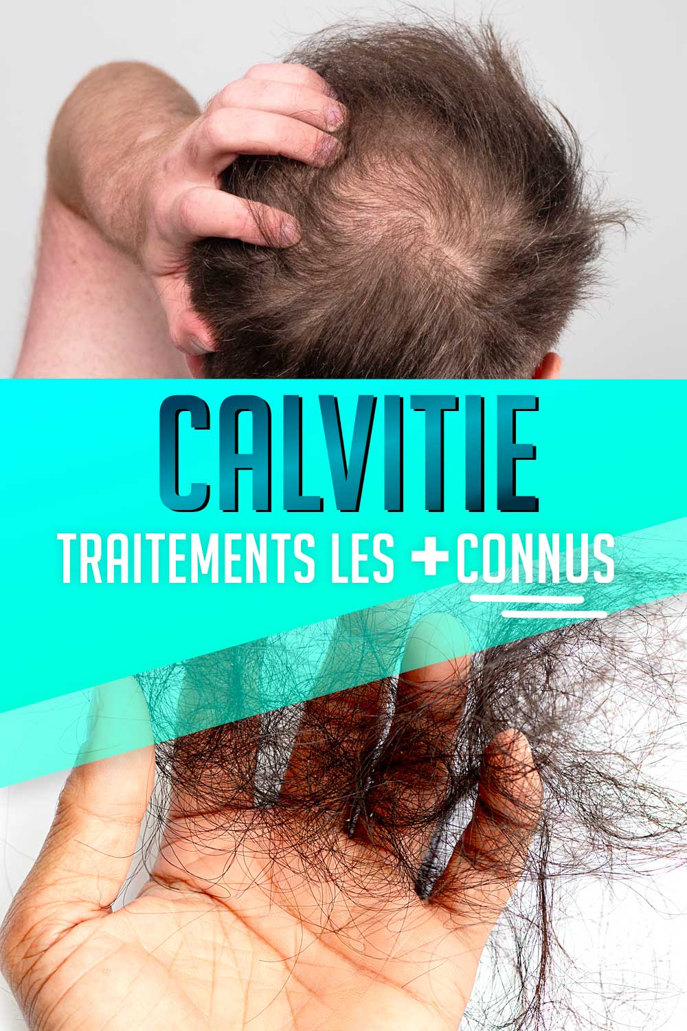 finastéride topique en france