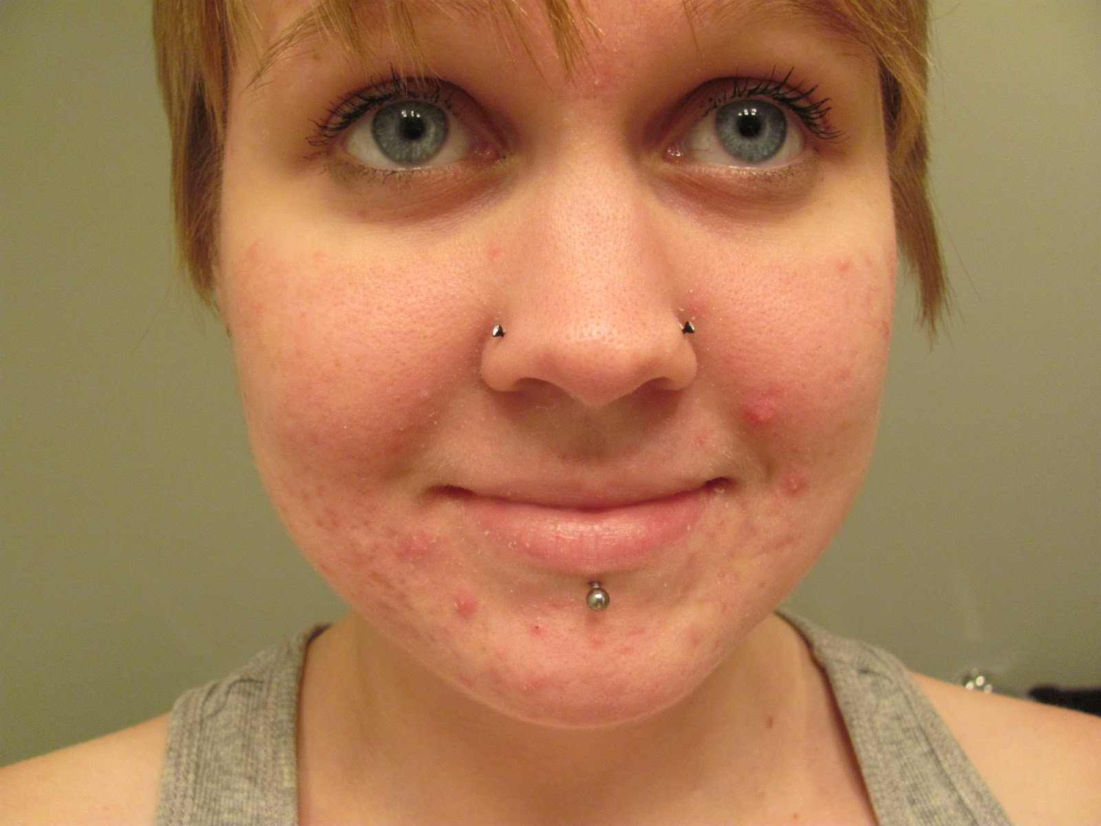 isotretinoin achat