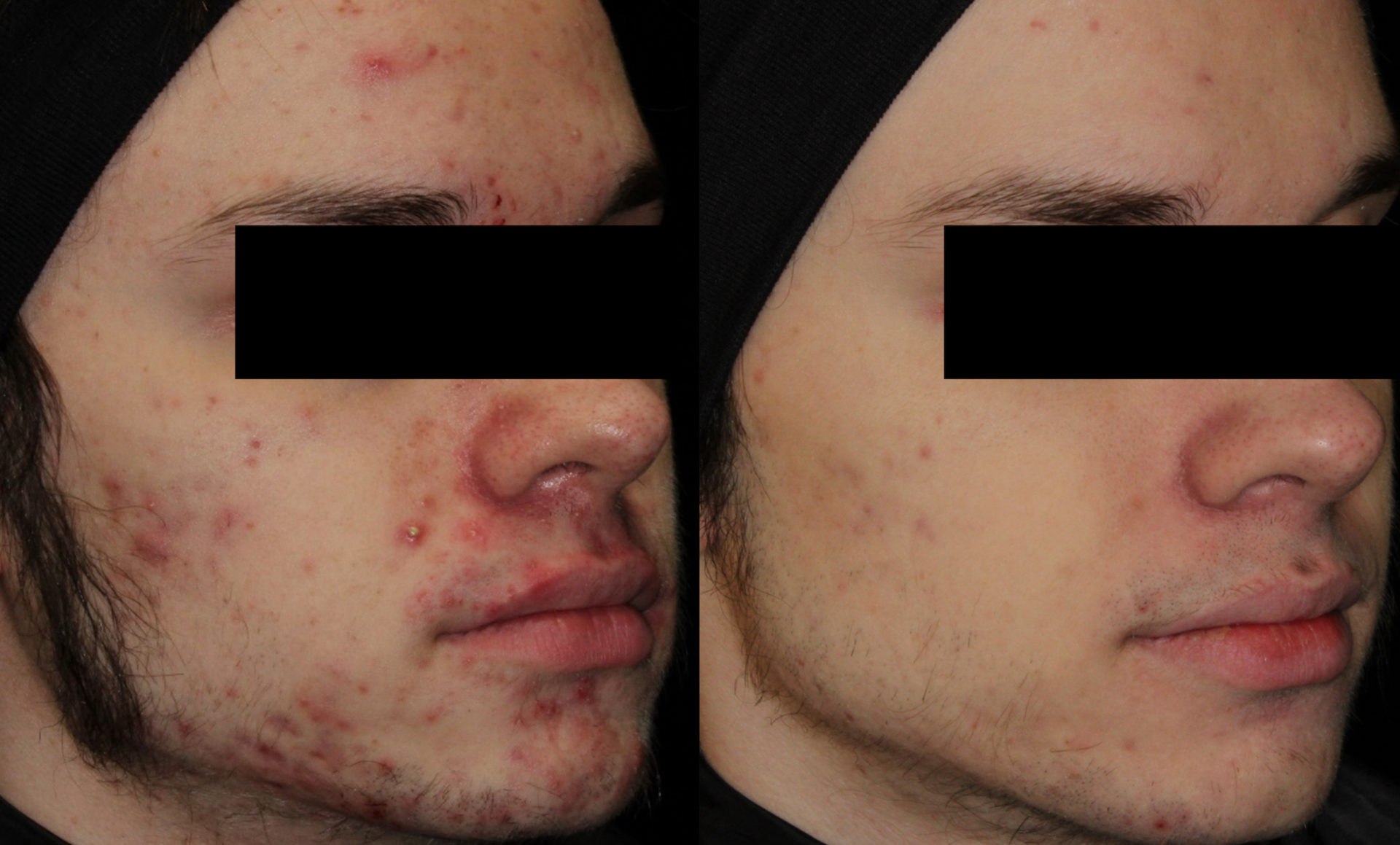 Isotretinoin pilule