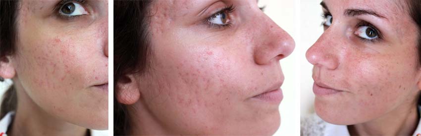Isotretinoin Pilule