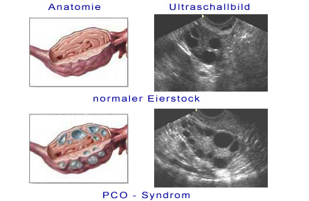 Metformin online pcos