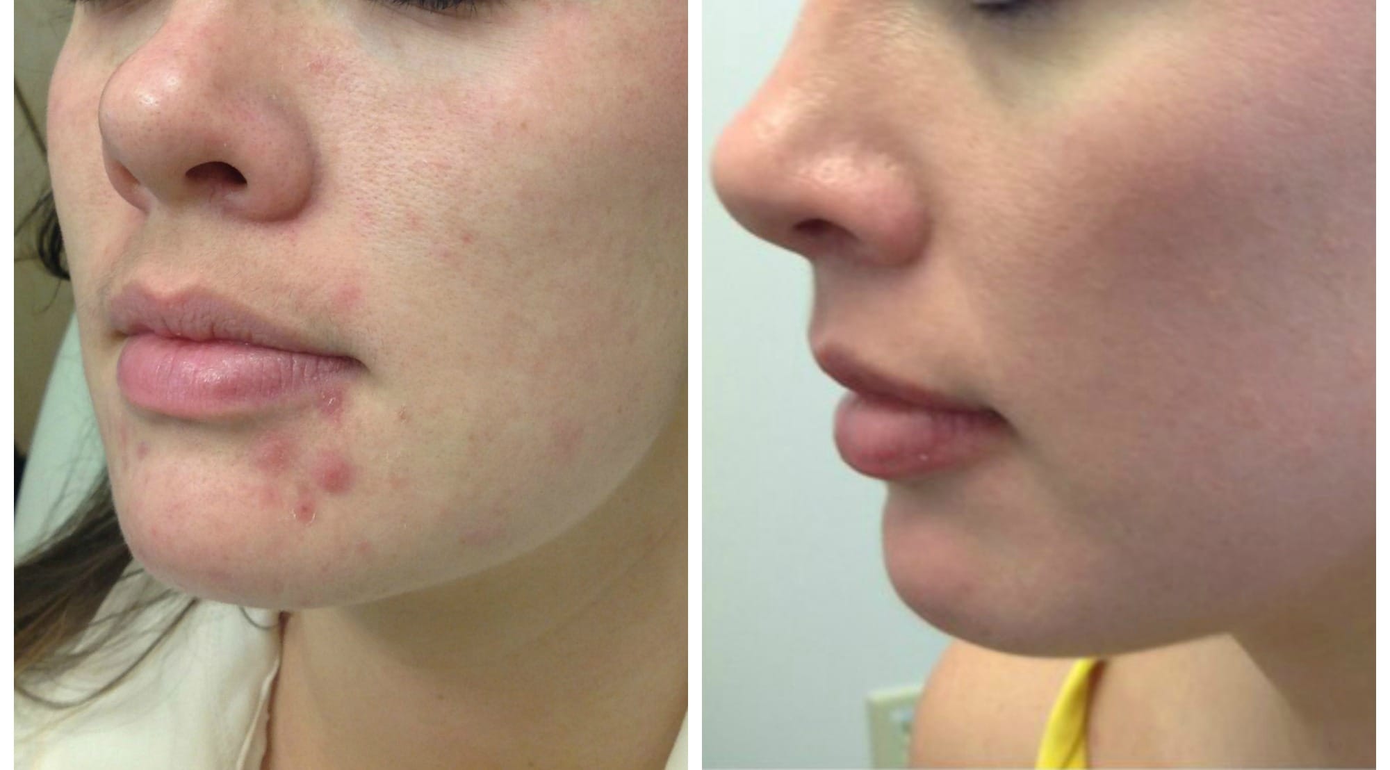 Online dermatologist accutane