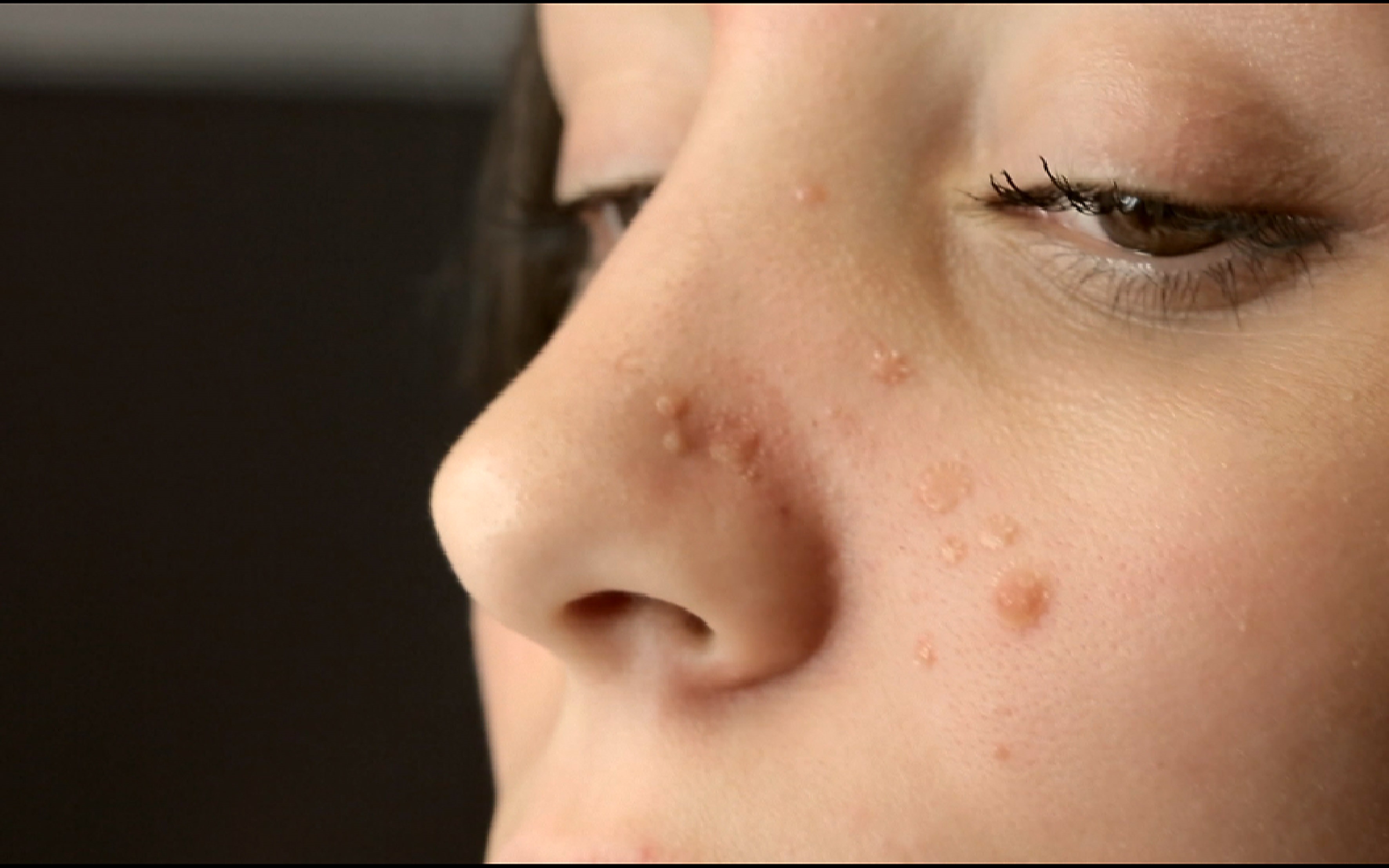 Pilule contre roaccutane