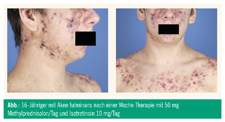Roaccutane 5mg