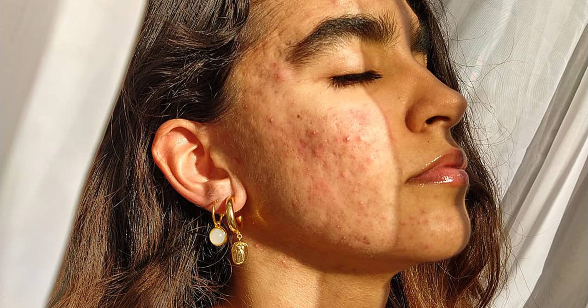 Roaccutane acné pilule