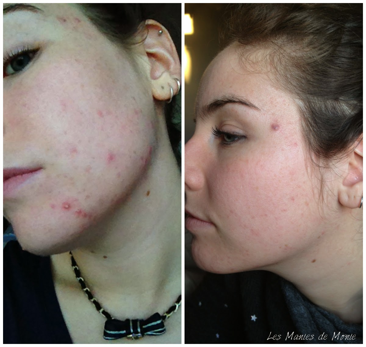 Roaccutane Arret Pilule