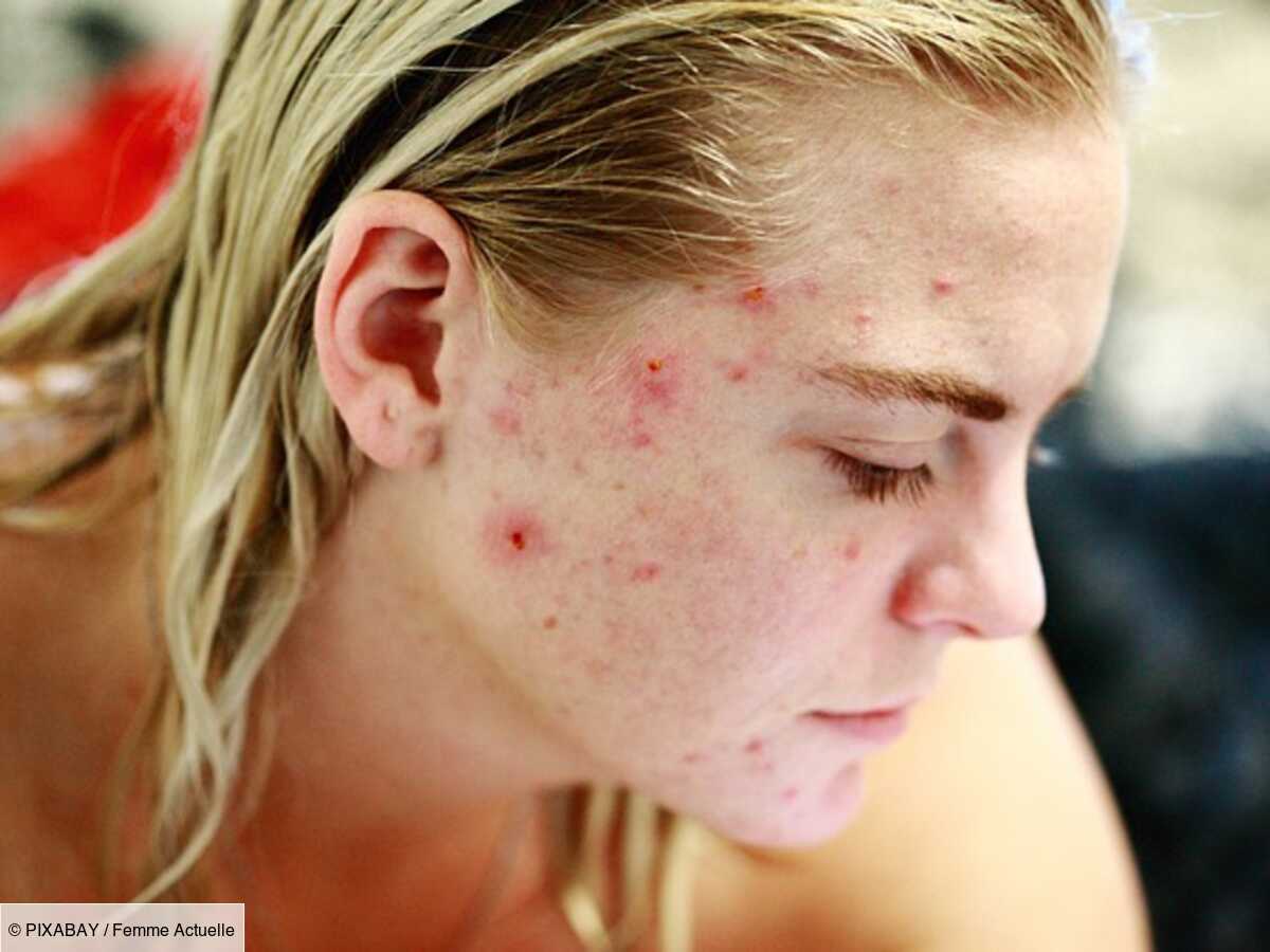 roaccutane générique