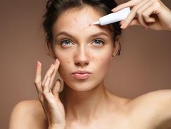 roaccutane prix