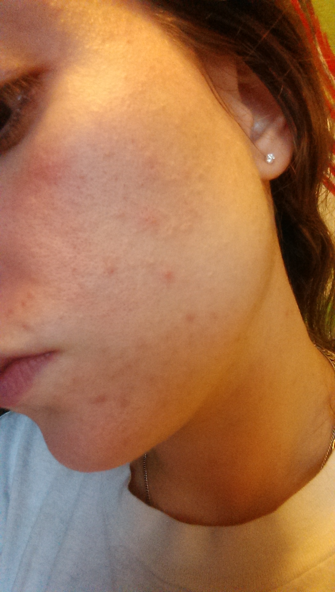 roaccutane sans contraception