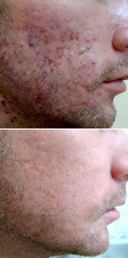 Roaccutane vente en ligne